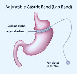 The Virtual Gastric Band